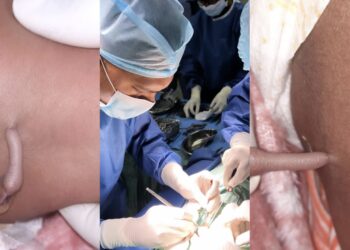 Baby born with tail.